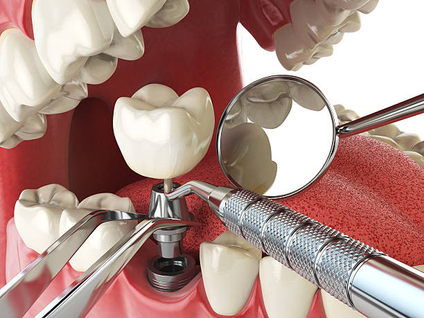 Best Emergency Root Canal Treatment in Marble Falls, TX